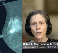 Debra L. Monticciolo, MD, FACR, FSBI, past-president of both the Society of Breast Imaging (SBI), and the American College of Radiology (ACR), explains the advances in breast screening technology and the positives and negatives of each and how artificial intelligence might be able to play a role to ease workflows.