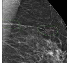 AI not currently safe to use as a standalone reader in breast cancer screenings.