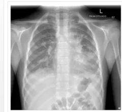 What mycoplasma pneumonia looks like on imaging.