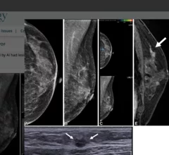AI spots contralateral cancer post-mastectomy