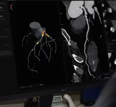 Australia-based Artrya Limited said its Salix Coronary Plaque module AI-powered cloud platform offers near-real time, point-of-care CCTA assessment and management of coronary artery disease.