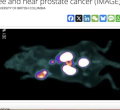 Dual-mode radiotracer helps surgeons 'hear' invisible cancer lesions