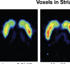 PET findings offer new hope for long COVID treatment