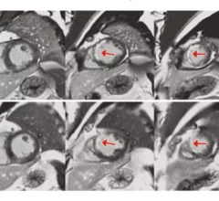 AI helps reduce needs for GBCA use during cardiac MRI scans