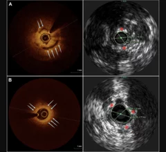Examples of OCT (left) and IVUS (right) images of two different subjects with calcium. Blue arrows denote calcium noted on OCT, red asterisks mark calcium on IVUS