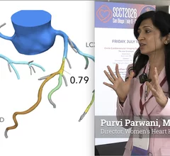 Purvi Parwani, MD, MPH, FACC, MBBS, cardiologist and assistant professor of medicine, director of the Women’s Heart Health Clinic, Loma Linda University Health, explains evidence that sex specific cut offs for treatment and risk factors in coronary CT angiography (CCTA) metrics may be needed because women often fall out of range in some risk measures for plaque, FFR-CT and stenosis. #SCCT #YesCCT #womenhearthealth