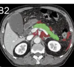 AI tool predicts which acute pancreatitis patients are vulnerable to organ failure