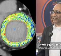 Amit Patel, MD, FSCCT, director of cardiac imaging, and a professor of medicine at the University of Virginia Health System, Charlottesville, explains how extracellular volume (ECV) is being used increasingly in cardiac CT to visualize structural remodeling and conditions like diffuse myocardial fibrosis, amyloidosis, or edema.