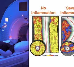 Caristo's fat attenuation index (FAI) AI-assessment for coronary inflammation in CCTA scans can visualize patient's residual cardiac risk not seen on traditional cardiac assessments.