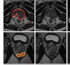 AI performs on par with radiologists at prostate cancer detection across diverse MRI datasets
