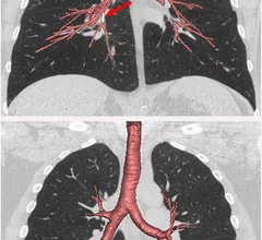 20180116-lungs.jpg Thumbnail