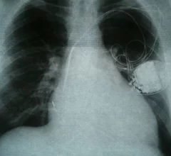 ImplantedPacemaker.JPG Thumbnail