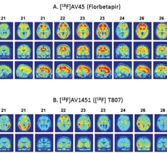 PET4Alzheimers.jpg Thumbnail