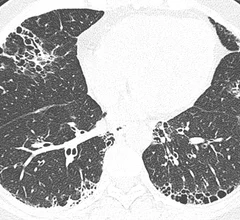 chest_ct_interstitial_pneumonia.jpeg Thumbnail
