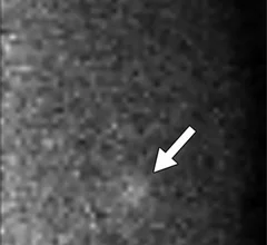 molecular_breast_imaging.jpeg Thumbnail