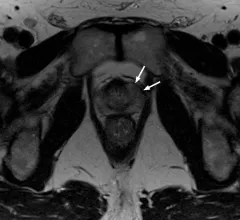 preoperative_MRI_prostatectomy.jpeg Thumbnail