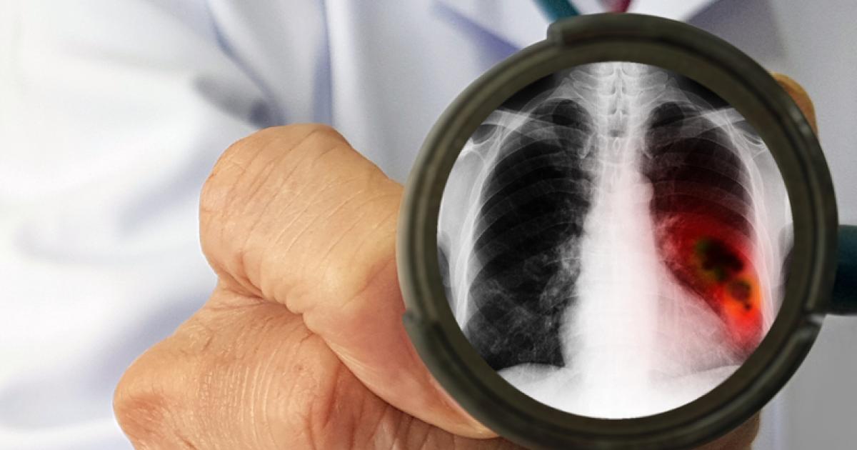 Radiology Partners study unearths 3 common barriers to lung cancer screening Radiology Partners study unearths 3 common barriers to lung cancer screening
