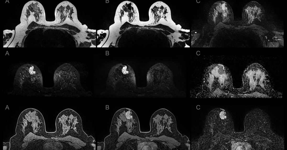 breast_mri_sequences_siemens_m