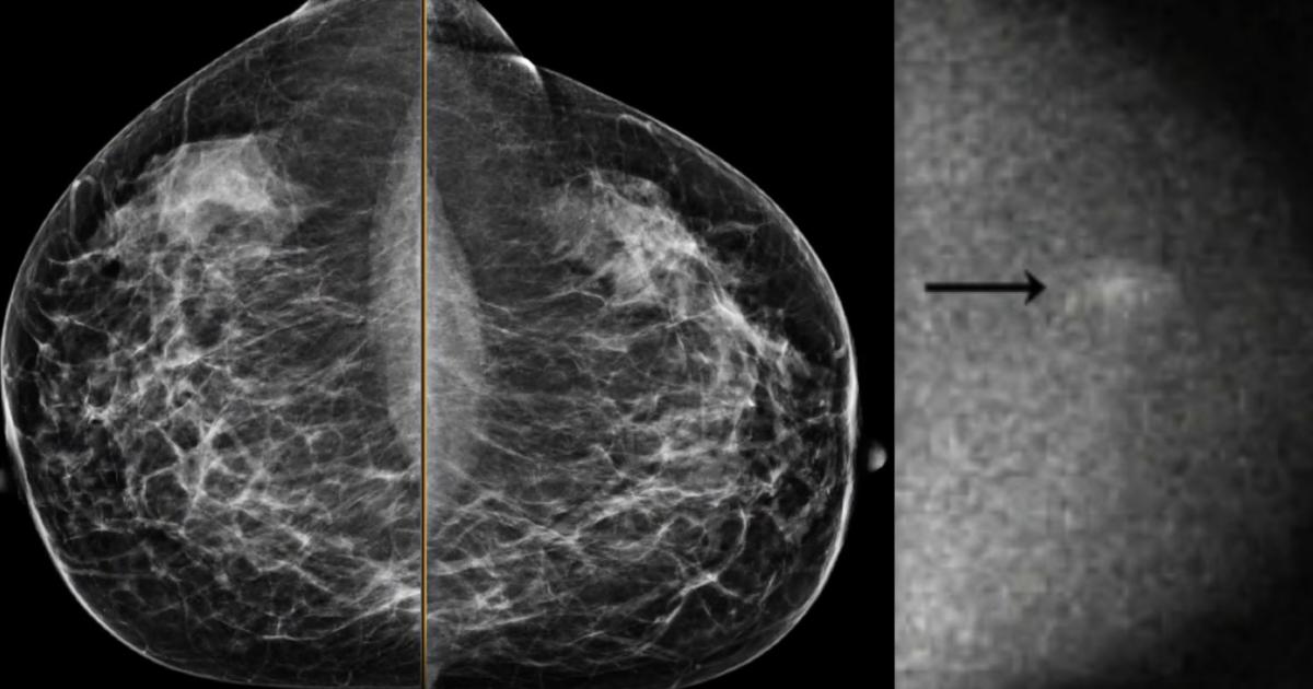 Diagnostic Breast Imaging 第2版 Diagnostic Imaging: Breast: 9780323548120: Medicine & Health