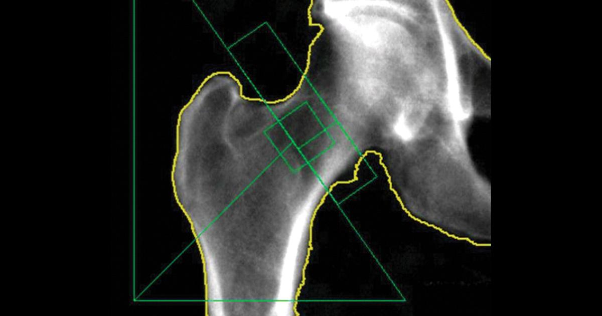 Bone Density, DEXA Scan, Imaging
