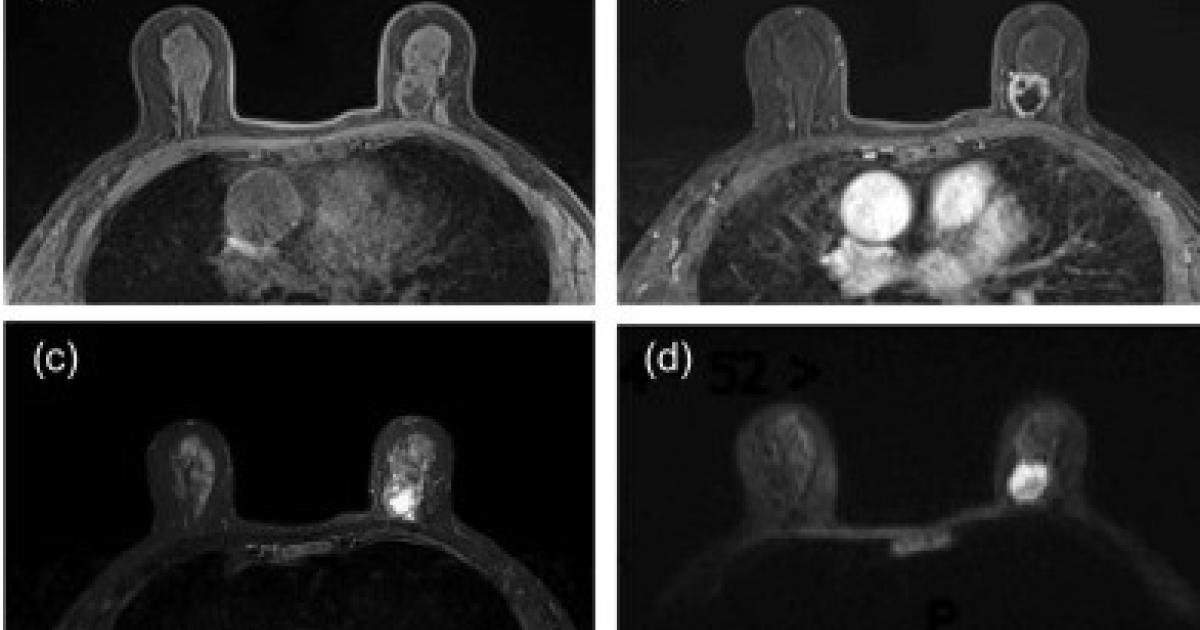 MRI radiomics could change the future of breast cancer treatment