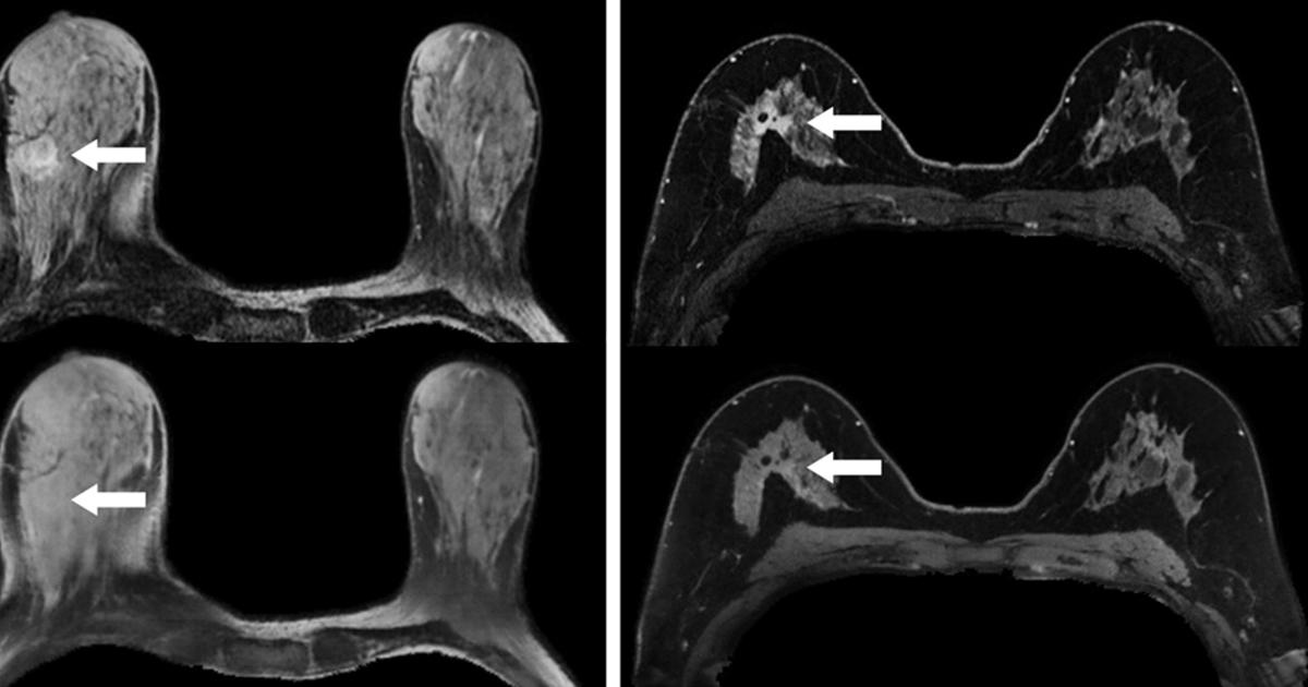 GBCA dose drops significantly in breast MRI thanks to machine learning