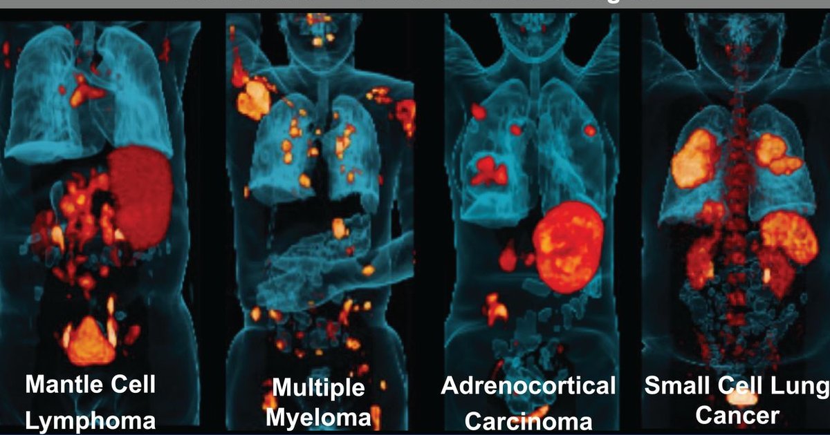 New radiotracer IDs numerous cancers likely to respond to targeted therapy