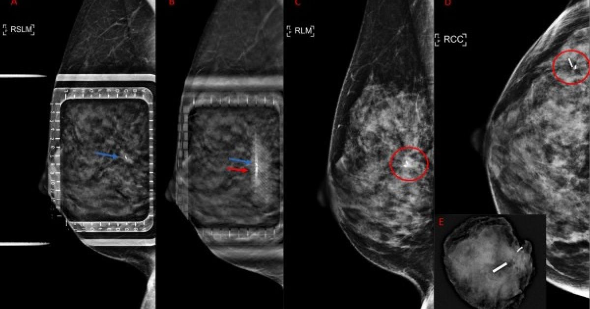 DBT guidance produces a significant drop in procedure time during