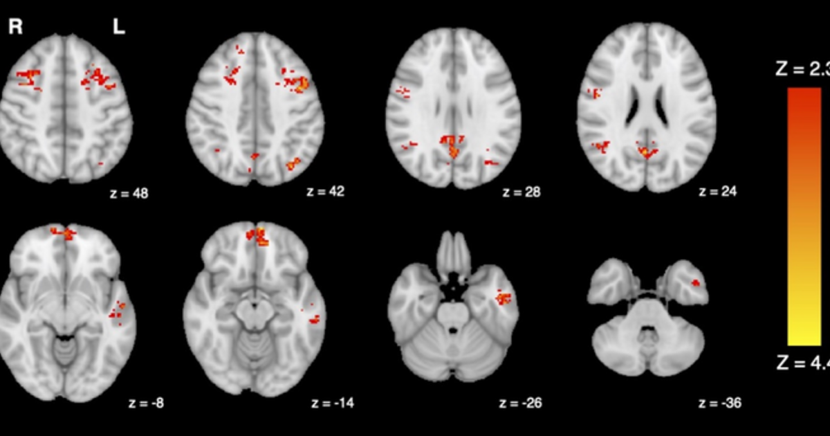 How patients' focus affects data derived from functional MRI scans