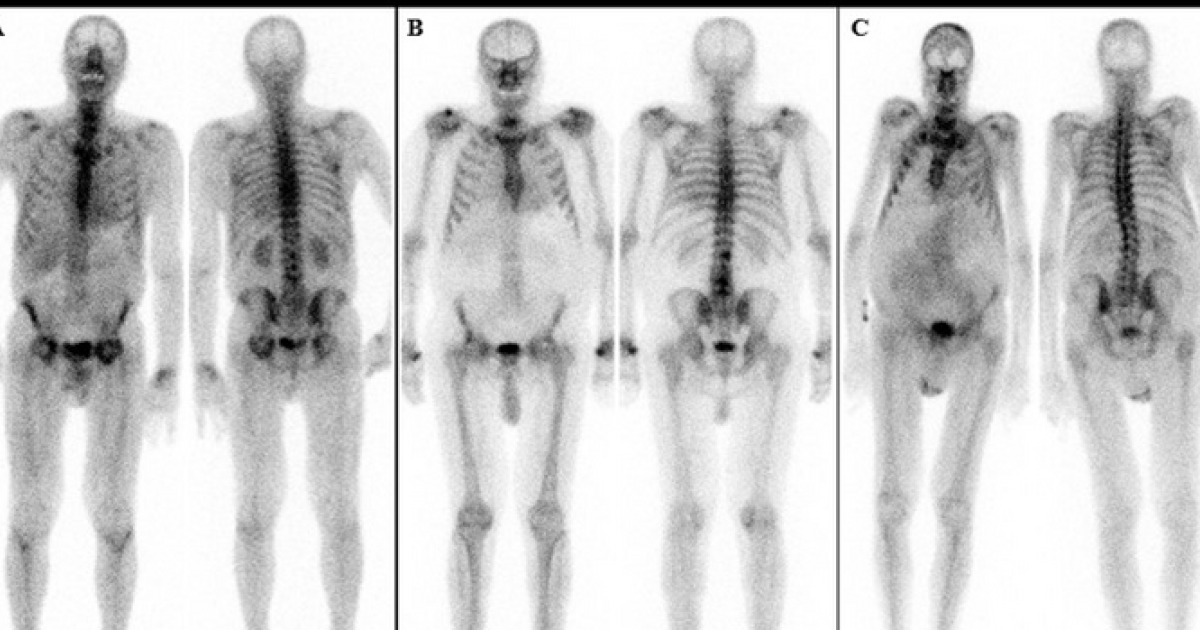 Cardiac amyloidosis becoming less rare thanks to nuclear