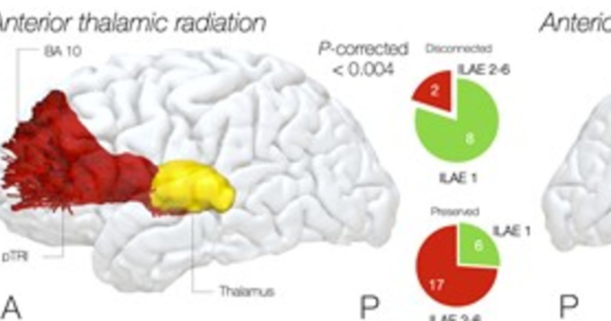 Experts use MRI to identify brain pathways responsible for epileptic ...