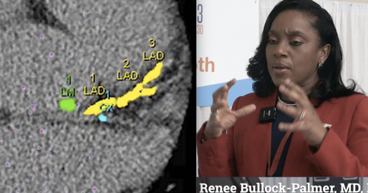 Caical CT calcium scoring can determine if patients need statins