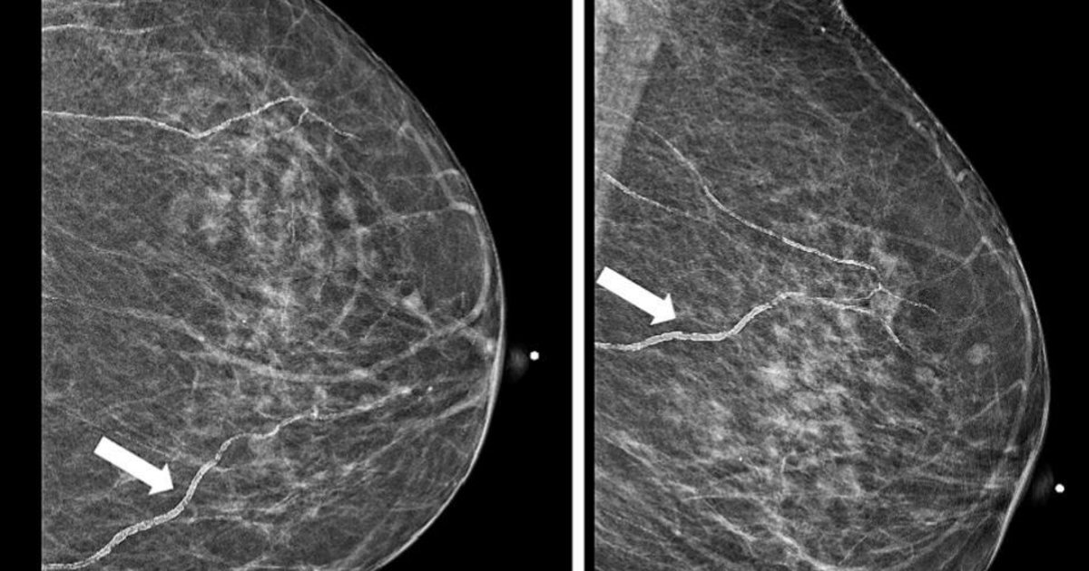 New mammogram policy: Maryland to require BAC notifications with first law of its kind