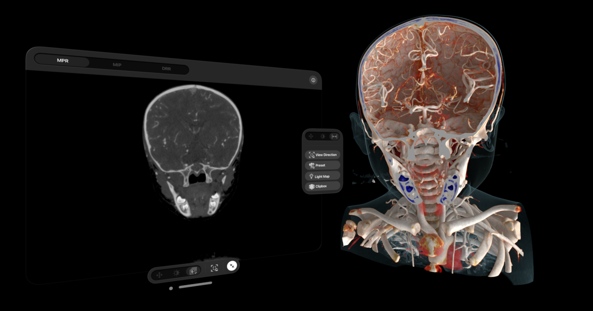 Apple Vision Pro app turns imaging scans into interactive holograms