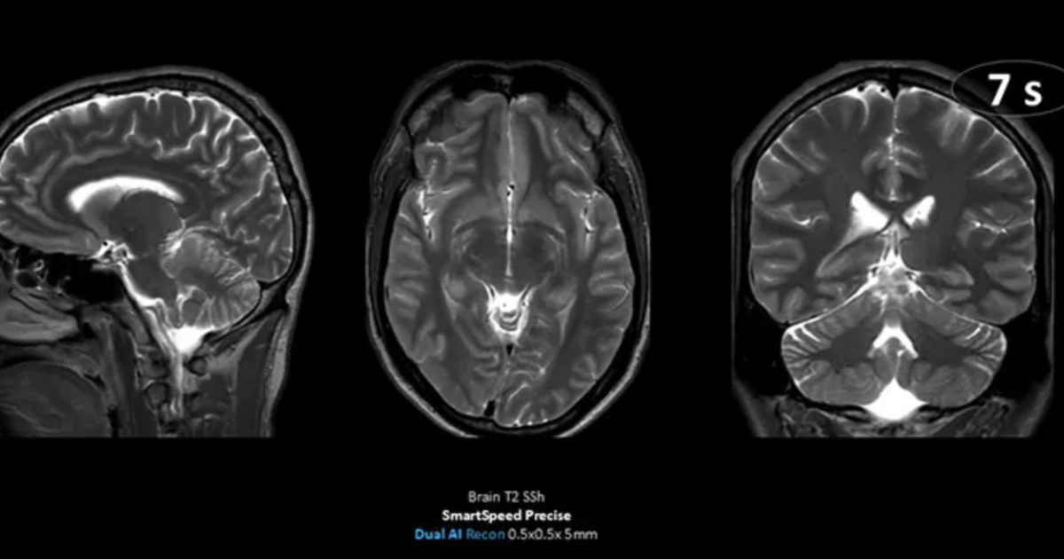 10-second brain MRI scans possible with newly FDA-cleared deep learning ...