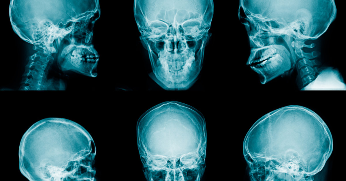 Low-value X-ray imaging for facial trauma still prevalent, despite CT’s superiority