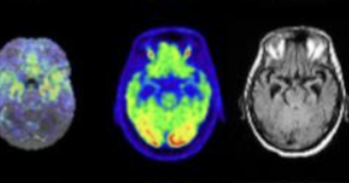 Combining PET and MRI data may be key to differentiating new type of ...