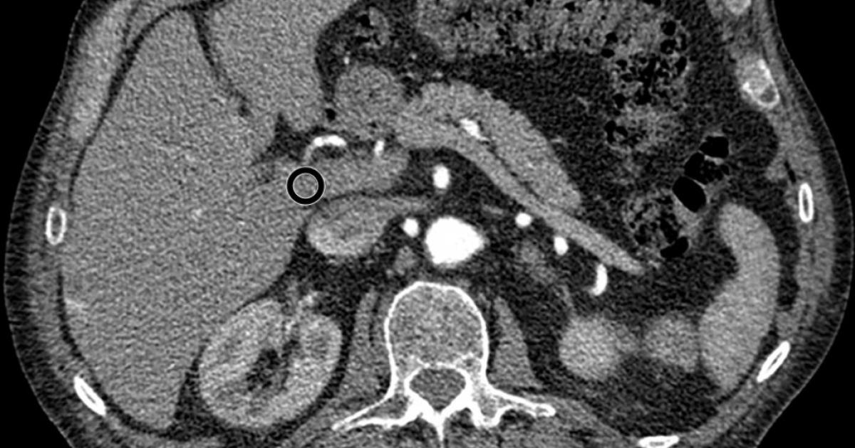 Combining automated tools decreases CT radiation dose