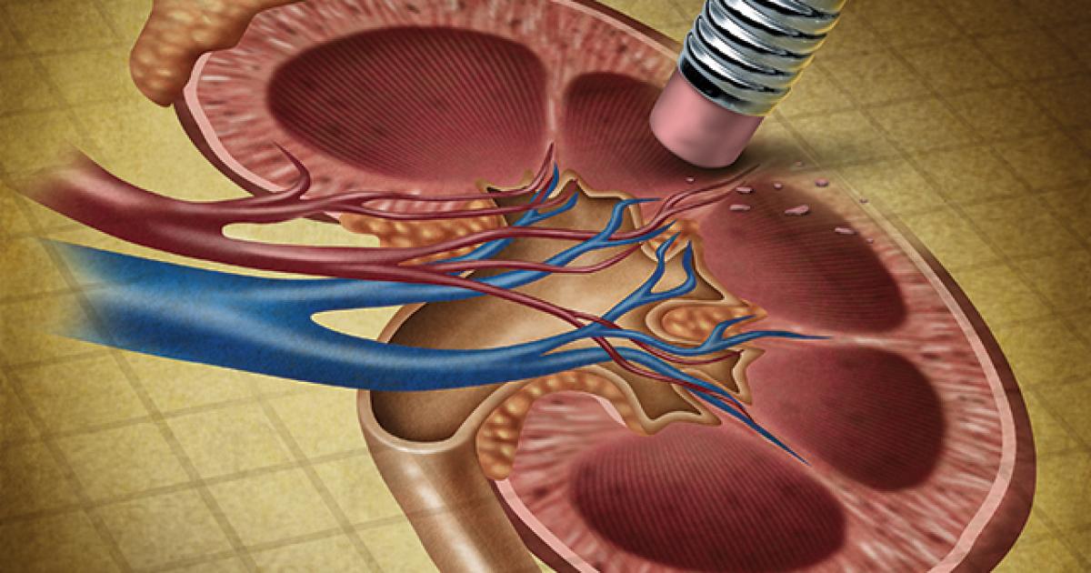 Biopsy before ablation has no cost advantage over both-at-once approach Biopsy before ablation has no cost advantage over both-at-once approach