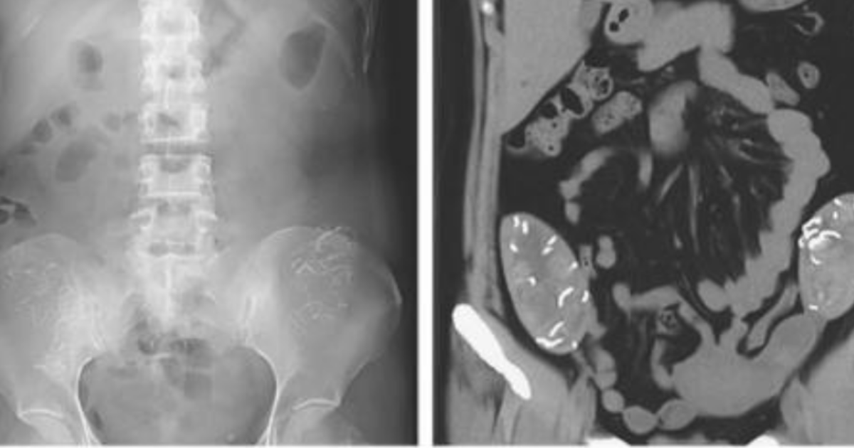 CT scan reveals surgical sponges left inside woman for 6 years