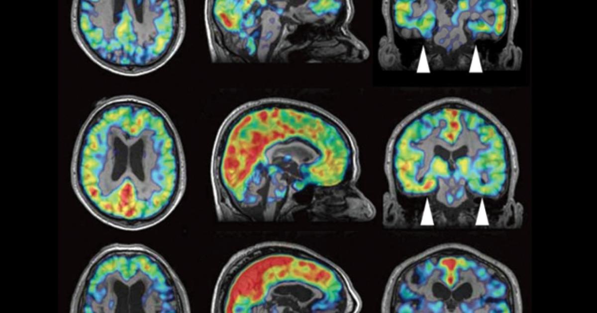 One step closer to invivo CTE diagnosis