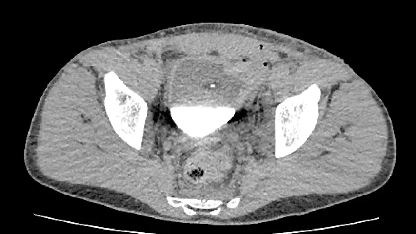 Bone fragment inside the bladder on CT. It broke off when a section of the pelvis shattered from the impact of penetrating shrapnel fraveling down from the abdomen. The fragment was hit with enough force to penetrate the bladder.  Laporotomy performed, resulting in bowel resection and bladder stoma. Image from Odrex Hospital, Odesa.