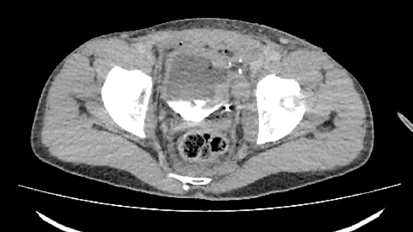 CT showing bone fragments the traveled deeper into the issue from the impact of shrapnel that shattered a portion of the pelvis near the bladder. Image from Odrex Hospital, Odesa.