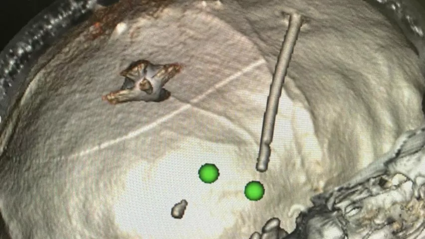 Ultrasound guidance was used to retrieve the shrapnel fragment from the brain, located in between the hemispheres of the brain after entering the front temple in Sofia, age 13. Ohmatdyt children's hospital in Kyiv removed the fragment. Trepanation of the skull performed to removed the fragment with the help of ultrasound. #woundedchildren #Ukrainwar #Standwithukraine