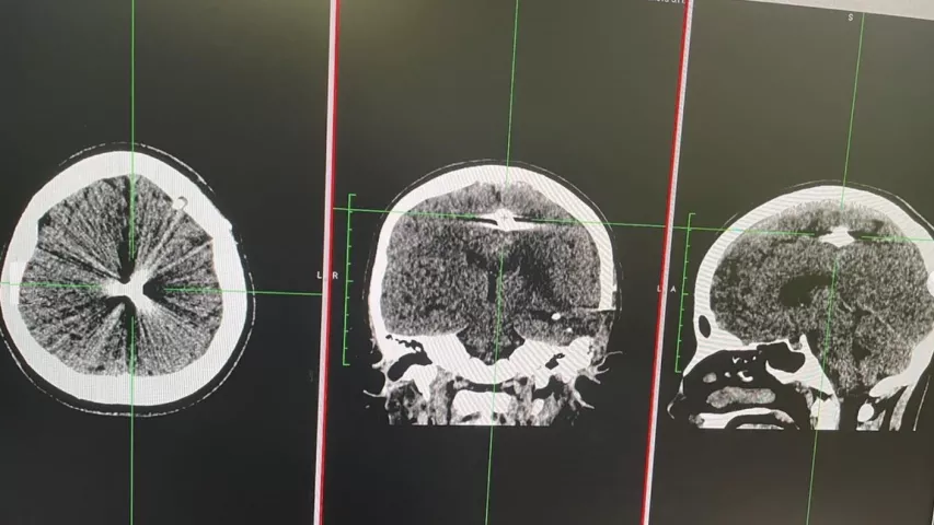 Brain CT scan showing shrapnel in between the hemispheres of the brain after entering fron front temple in Sofia, age 13, from the Mykolaiv region, located along the Black Sea coast between Kherson and Odesa. She was struck in the head by shrapnel from a Russian rocket artillery bombardment of her village March 5. Moved to Ohmatdyt children's hospital in Kyiv March 29 to remove the fragment. The shrapnel. Trepanation of the skull performed to removed the fragment with the help of ultrasound. #Ukrainewar