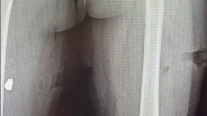 X-ray showing a chunk of Russian mortar shrapnel in the right thigh after first entering and exiting the left thigh of female pediatric patient Varya, age 7. The fragment that was surgically removed from her leg. The family waited a few days and decided it was time to evacuate the Kyiv suburb of Irpin as the Russians began to surround the city. The relatives drove to a Russian checkpoint in two cars and Russian soldiers began firing mortars at the cars. #Ukraine #StandwithUkraine ##Ukrainewar