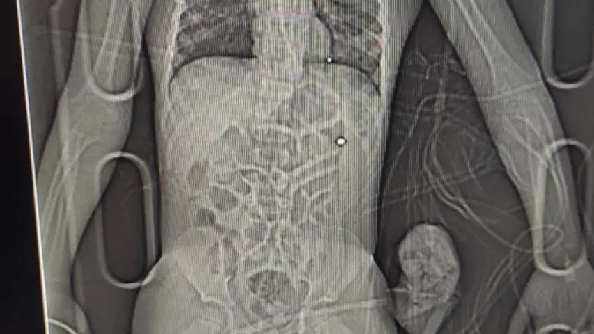 Digital X-ray of a boy from Kyiv area who was shot during the Russian advance on the city. Wounded on his side and neck and had a concussion. In the intensive care at Ohmatdyt pediatric hospital (https://ohmatdyt.com.ua/en/) intensive care unity in Kyiv Feb. 27, 2022. The military called an ambulance, and doctors performed an emergency surgery. #Standwithukraine #Ukarine #Ukrainewar