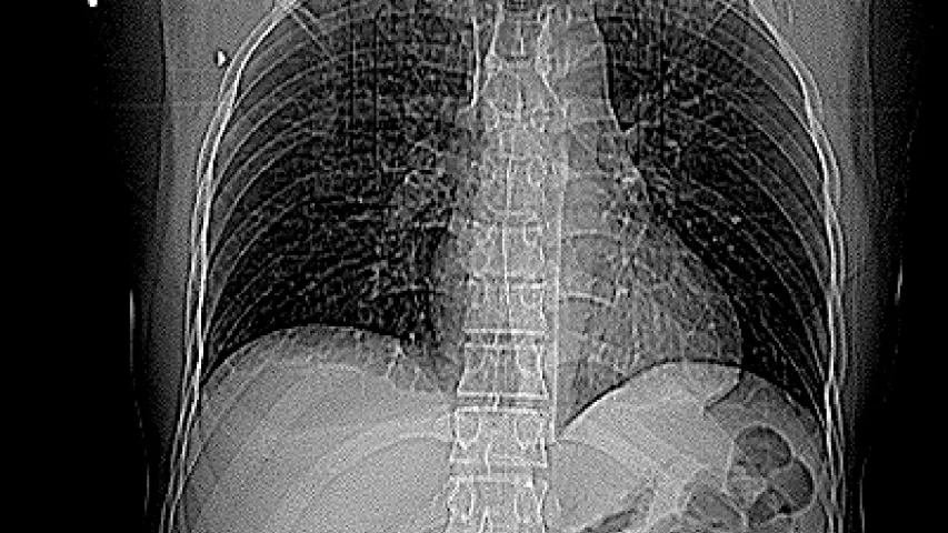 Scout CT scan showing two pieces of shrapnel fragments on left side of the image, under the arm. This is a foreign soldier who volunteered to fight for Ukraine, wounded in combat at Nikolayv. Multiple fragments of shrapnel penetrated the abdomen and fractured the pelvis. Laporotomy performed, resulting in bowel resection and bladder stoma, to divert urine and feces out of a port in the abdomen. Chest and head CT also performed to assess shrapnel wounds in the chest and face. Image Odrex, Odesa. #Ukraine