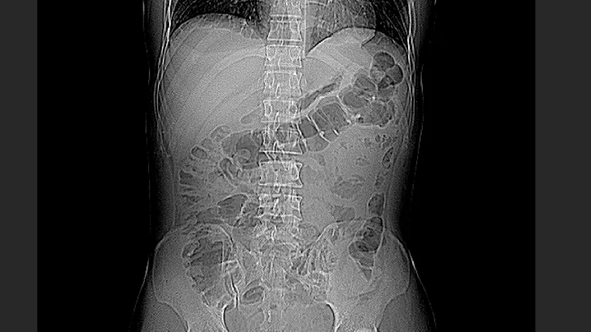 A CT scout scan with at least 6 shrapnel fragments visible in the right side of the chest and in the pelvis. Image from Odrex Hospital, Odesa. #Ukraineradiology #Ukrainewar