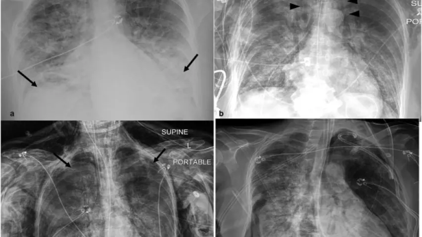 COVID ventilator complications due to barotrauma. Barotruama over 39 days: 56 year old female with RT-PCR confirmed COVID-19 and a history of ulcerative colitis intubated 1 day post admission. (A) Frontal chest radiograph on presentation demonstrates bilateral opacities (arrows) in a basilar predominant pattern, compatible with COVID-19 pneumonia. (B) Pneumomediastinum (arrowheads) and subcutaneous emphysema (arrows) developed 2 day post intubation. Image courtesy of Clinical Imaging. COVID presentations.